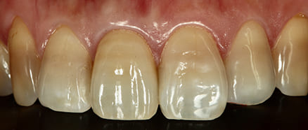 前歯右1番セラミッククラウン治療後