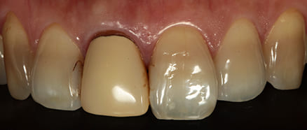 前歯右1番セラミッククラウン治療前