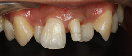 前歯左1番セラミッククラウン治療前