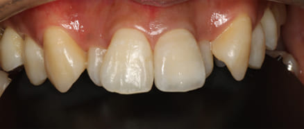 前歯左1番セラミッククラウン治療後