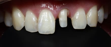 前歯左1番セラミッククラウン治療前