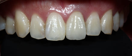 前歯左1番セラミッククラウン治療後