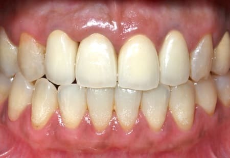 ガムピーリング［1］術後