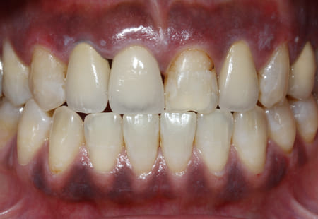 ガムピーリング［1］術前