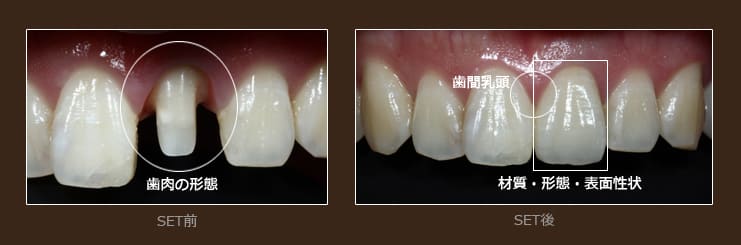 より自然に調和がとれた歯と歯ぐき