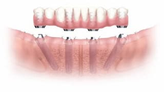 オールオンフォー (All-on-4)