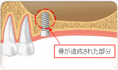 ソケットリフト