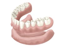 総入れ歯