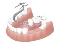 部分入れ歯