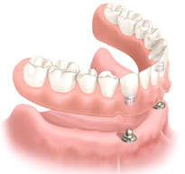 ボールアバットメント