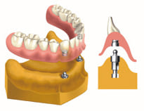 ボールアバットメント2