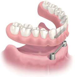バータイプオーバーデンチャー