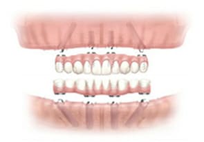 オールオンフォー