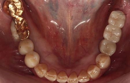 インプラント治療［1］咬合面術後