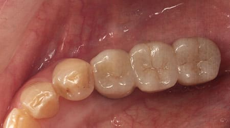 インプラント治療［1］埋入部位術後