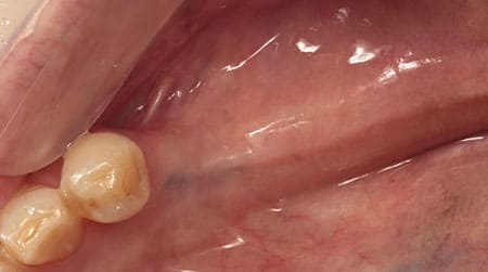 インプラント治療［1］埋入部位術前