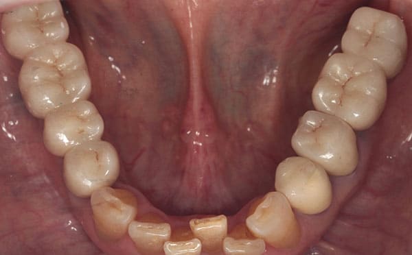インプラント治療［2］術後