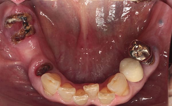 インプラント治療［2］術前