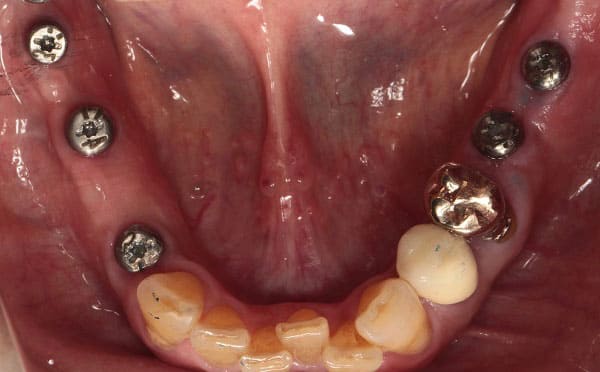 インプラント治療［2］インプラント埋入後