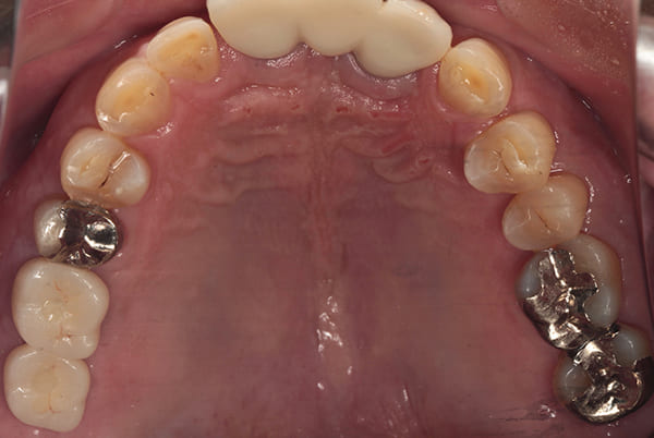 インプラント治療［3］咬合面術後