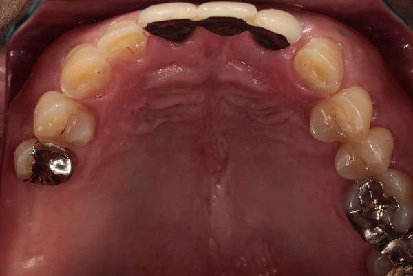 インプラント治療［3］咬合面術前