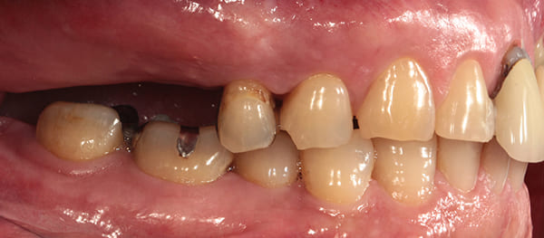インプラント治療［3］側方面術前