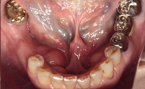 インプラント治療［4］咬合面術前