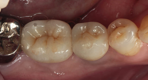 インプラント治療［4］咬合面術後