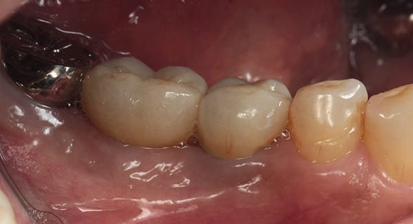 インプラント治療［4］側方面術後