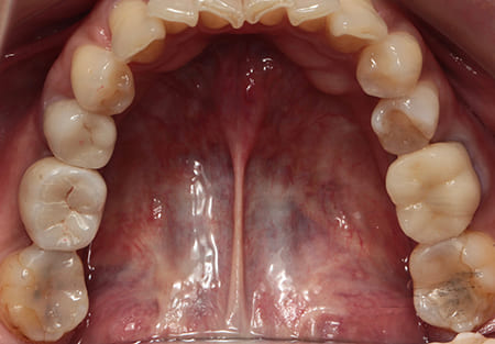 インプラント治療［5］咬合面術後