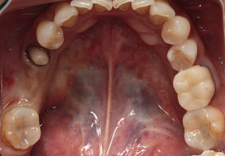 インプラント治療［5］咬合面術前