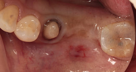 インプラント治療［5］術前埋入部位の拡大
