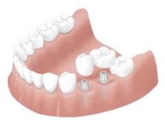 インプラント治療