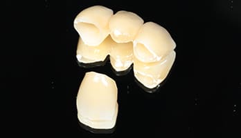 ブリッジ治療で美しい歯が生える⁉