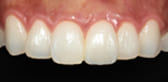 セラミック矯正