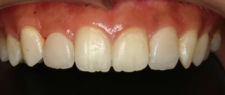 ラミネートベニア［1］術後