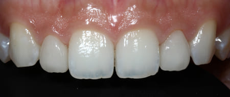 ラミネートベニア［2］術後