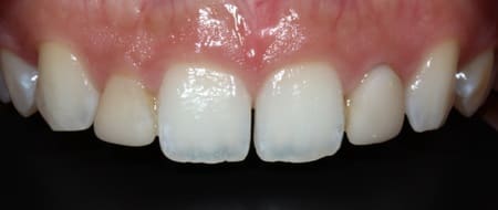 ラミネートベニア［2］術前