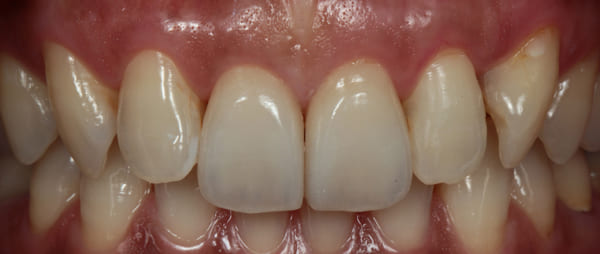 ラミネートベニア［3］正面術後