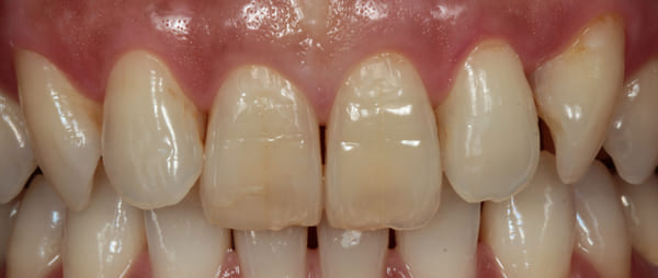 ラミネートベニア［3］正面術前