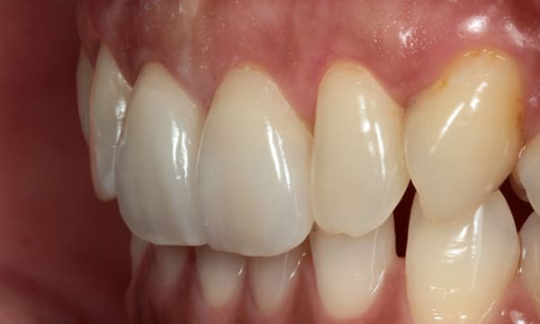 ラミネートベニア［3］サイド術後