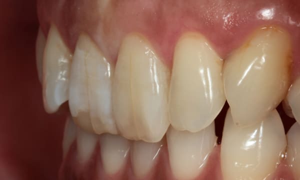 ラミネートベニア［3］サイド術前