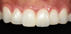 歯は削らず神経を残す