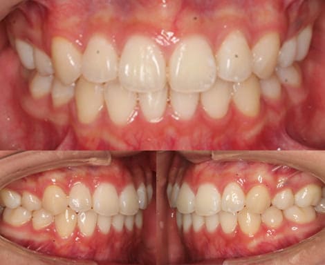 舌側矯正・裏側矯正［抜歯矯正］正面左右術後
