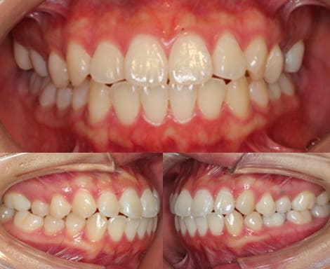 舌側矯正・裏側矯正［抜歯矯正］正面左右術前