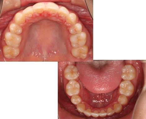 舌側矯正・裏側矯正［抜歯矯正］咬合面術後