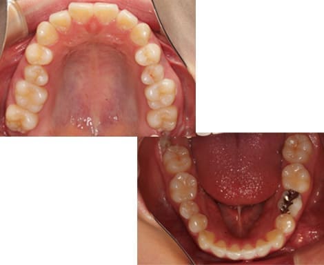 舌側矯正・裏側矯正［抜歯矯正］咬合面術前