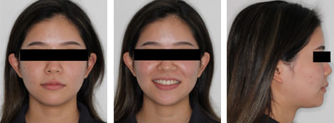 舌側矯正・裏側矯正［抜歯矯正］顔貌術後