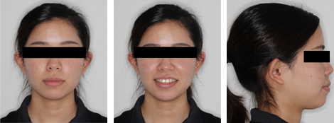 舌側矯正・裏側矯正［抜歯矯正］顔貌術前