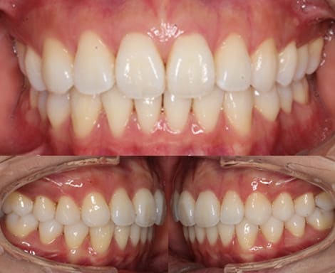 舌側矯正・裏側矯正［非抜歯矯正］正面左右術後